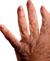 Cataplasma de confrei usado para artrite