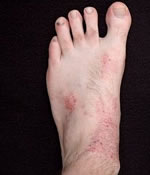 Dermatite atópica sintomas