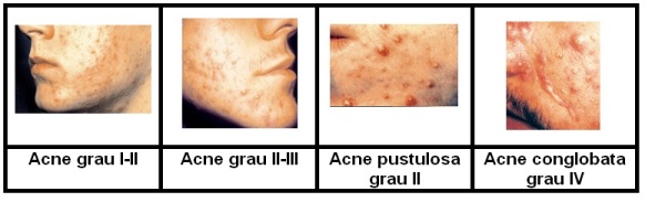 tipos-acne