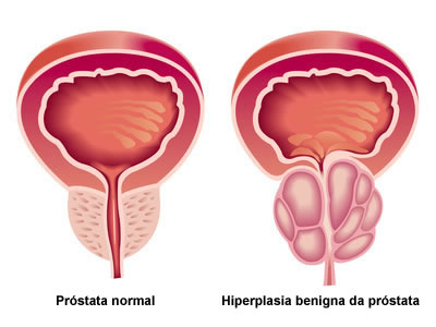 hiperplasia benigna da próstata sintomas