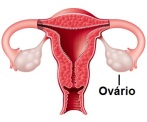 Definição câncer de ovário