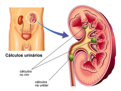 Cálculos urinários: causas & tratamentos | Criasaude