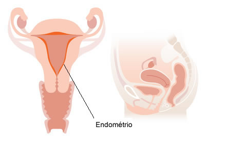 Entrevista sobre endometriose com a Dra. Rosa Maria Neme