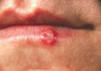 causas herpes labial