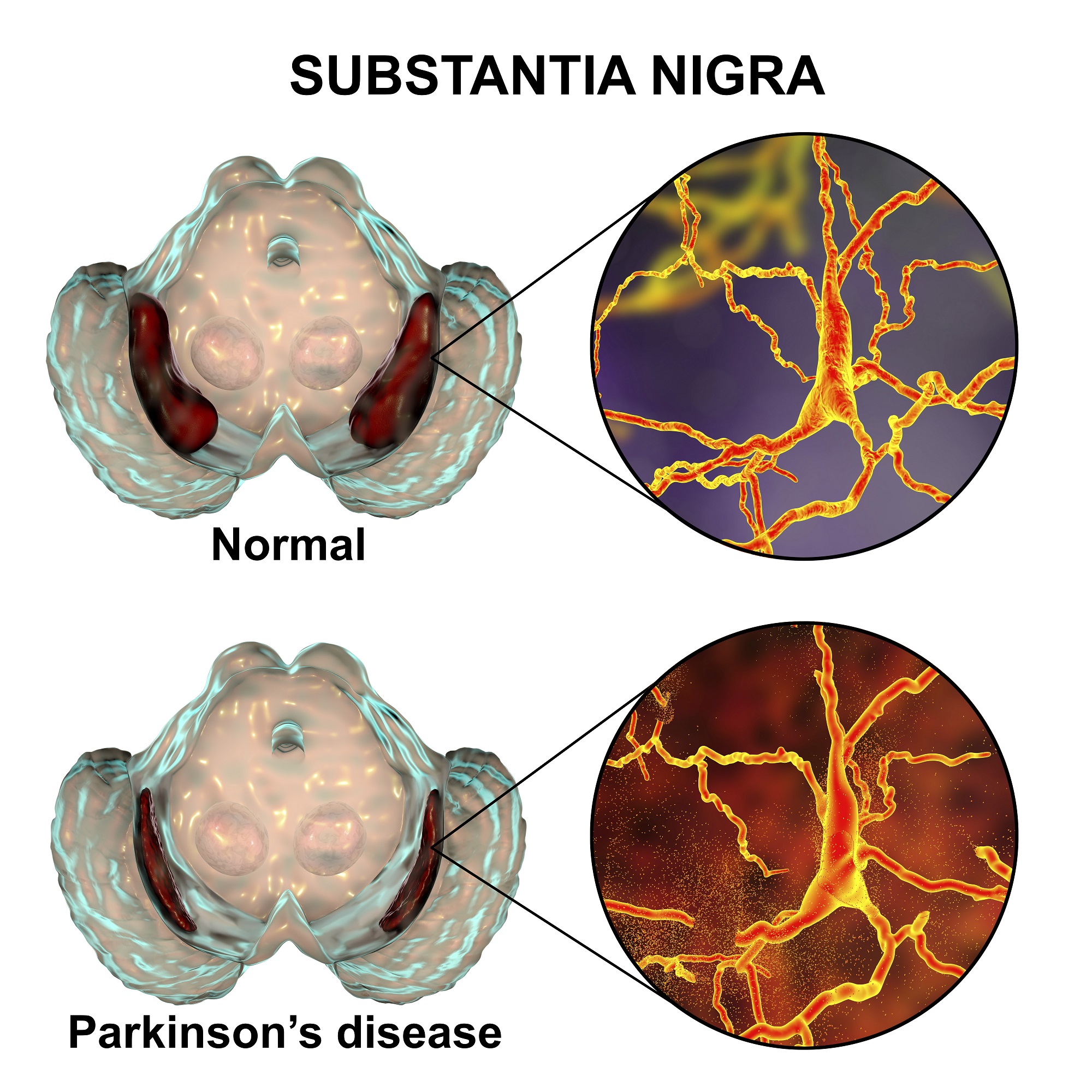 Ooforectomia bilateral e aumento do risco da doença de Parkinson